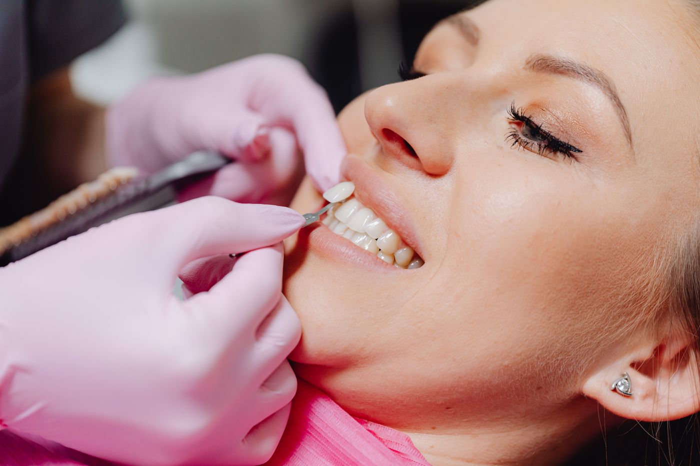 Close-up of a dental veneer being placed
