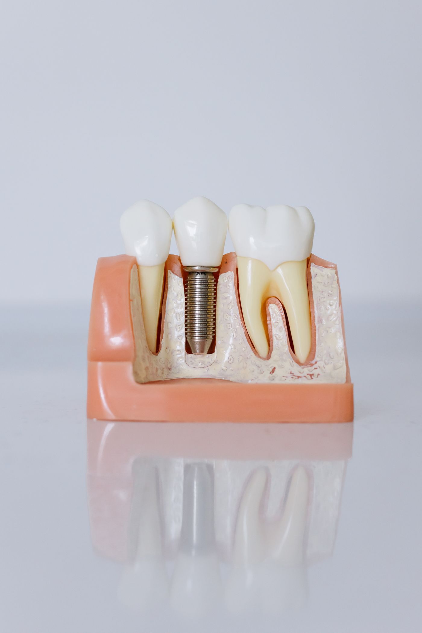 Model of a dental implant with crown and gum
